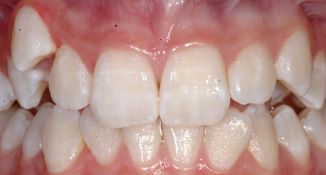 blocked out cuspid non extraction