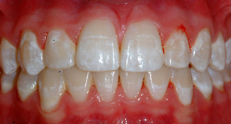 blocked out cuspid non extraction