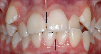 blocked out cuspid extraction