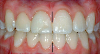blocked out cuspid extraction