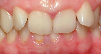 crossbite and deep bite