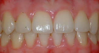 crossbite and deep bite