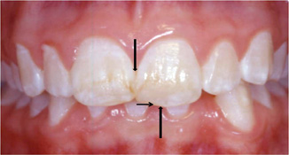 deep bite and crowding