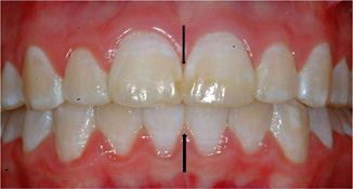 deep bite and crowding