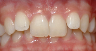 class II divsion II deep bite