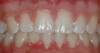 class II divsion II deep bite