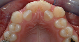 blocked out laterals non extraction