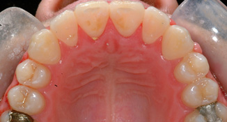 blocked out laterals non extraction