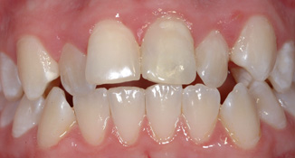 blocked out laterals