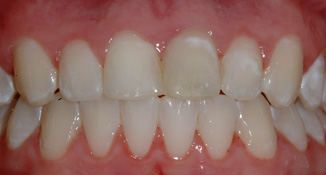 blocked out laterals