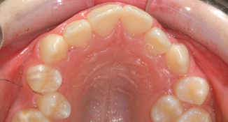 blocked out upper back teeth