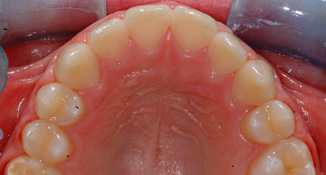 blocked out upper back teeth